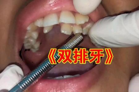牙齿之谜:解读你的命运与性格特征