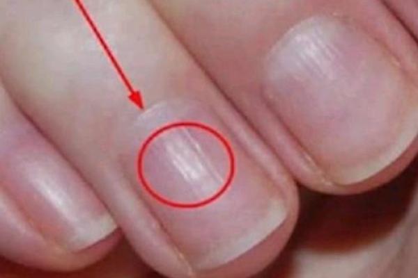 指甲凸起竖纹的女人：命运与健康的深刻解读与影响