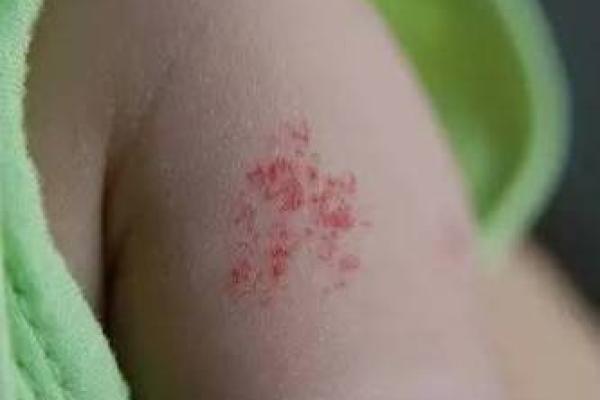 腿上有胎记的命运：揭开神秘的面纱，探寻人生的轨迹