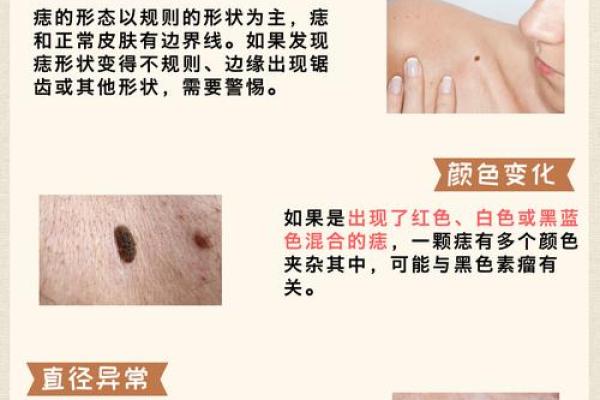 痣的秘密：全身长痣与命运的微妙关系揭示
